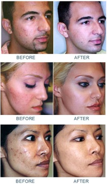 Clearogen лечит прыщи и подавляет ACNEZINE из США.