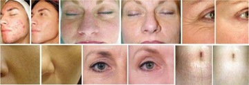 3x дермароллера BODY FACE EYES Dermaroller 3in1