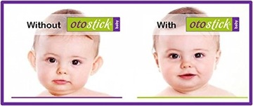 Otostick Baby Aesthetic Ушные корректоры для детей