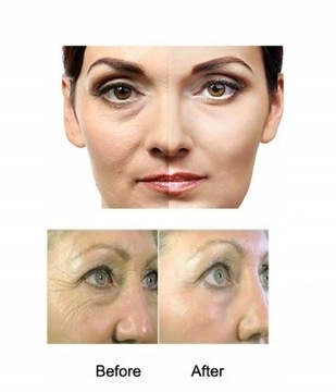 Derma Roller 540 Tytan 0,2 мм Дермароллер GOLD