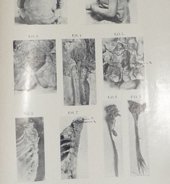 ПОСВЯЩЕНИЕ МИЕЛОШИЗА Грыжа спинная Т.РОГАЛЬСКИ