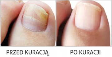 FARMONA PODOLOGIC СЫВОРОТКА ДЛЯ НОГТЕЙ онихолизис 15 мл