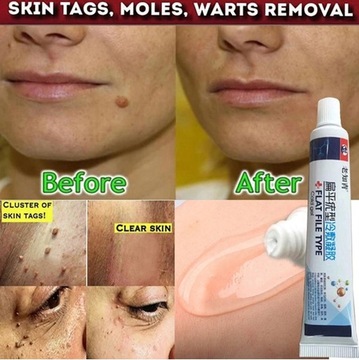 Мазь для удаления кондилом вульвы и бородавок