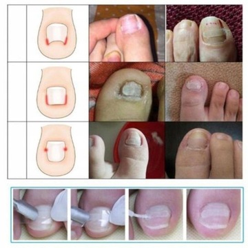 Пластыри для исправления вросших ногтей. Оформление ногтей