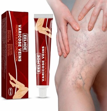 Varicocele Cream Relieves Phlebitis and Vasculitis