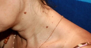 ФИБРОМЫ БОРОРОВКИ НАРАСТИЯ НА ШЕЕ ТЕЛА ПРЕПАРАТ Чистотел СИЛЬНЫЙ