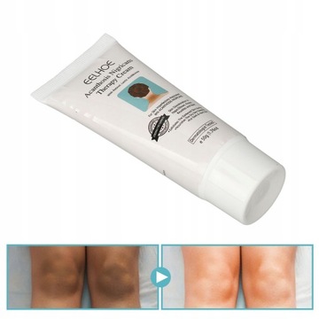 KREM LECZNICZY NA ACANTHOSIS NIGRICANS 100g