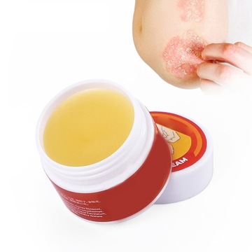 Eczema Psoriasis Dermatitis Pruritus Ointment