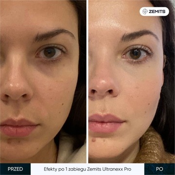 Подъемное устройство SMAS Zemits UltraNexx Pro