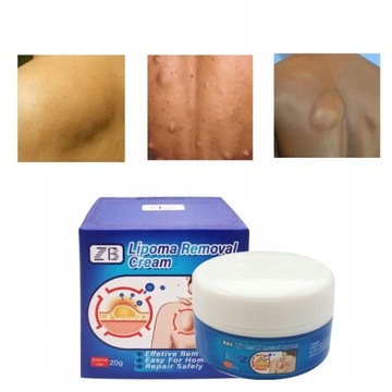 'Cream Effectively Removes Lipomas 20g