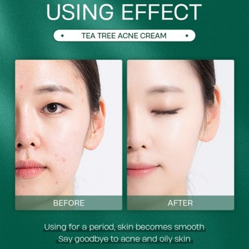 20 г крем для лица против прыщей для контроля жирности и гидратации