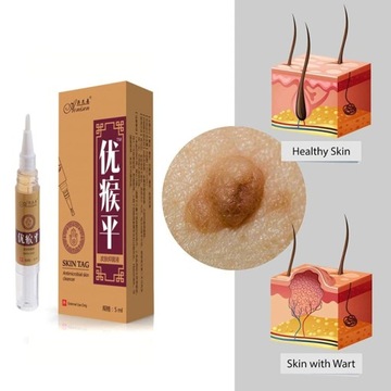 Против родинок и генитальных бородавок