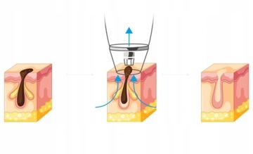 ПЫЛЕСОС BLACKHOES DIAMOND MICRODERMABRASION