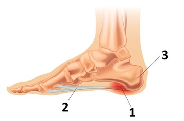 ОРТОПЕДИЧЕСКИЕ СТЕЛКИ ПРИ АТЕНСИТЕ СТОПЫ