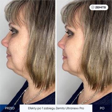 Подъемное устройство SMAS Zemits UltraNexx Pro