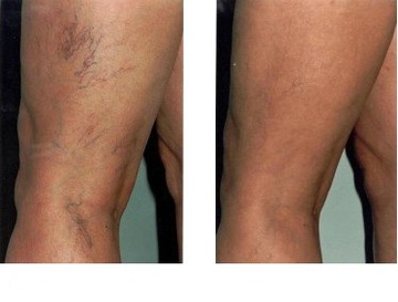 Vein Vanish / РАЗРУШЕНИЕ КАПИЛЛЯРОВ, сосудистая кожа