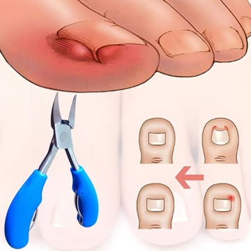 Cążki cęgi do wrastających grubych paznokci u stóp obcinacz pedicure