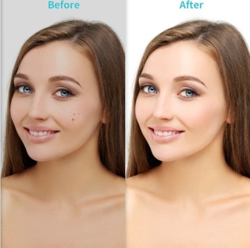 Xpreen профессиональный электрокоагулятор для удаления пятен