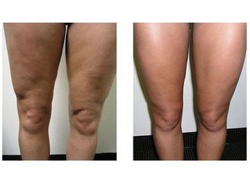 MNS DERMA РОЛИК 192 - ТРУБКА 2,0 мм