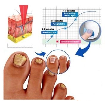 LASEROWE URZĄDZENIE DO LECZENIA GRZYBICY PAZNOKCI