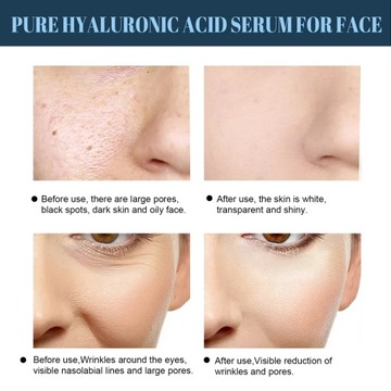 Коллагеновые абсорбирующие лифтинговые нити против морщин