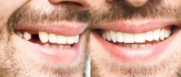Зубные имплантаты Happy Smile Cosmetic