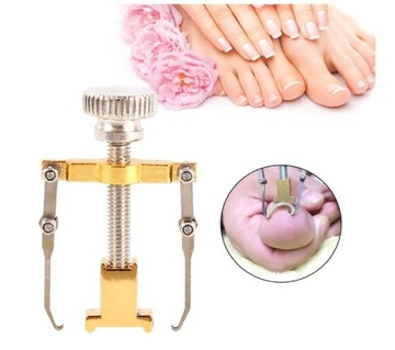 Брекет от вросших ногтей на ногах Вросший ноготь на ногах