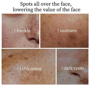 Skuteczny wybielający krem do piegów usuń Melasma ciemny krem do