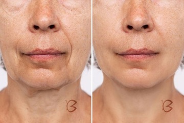 Beautifly 5903003701033 B-Glossy Blush мезотерапия