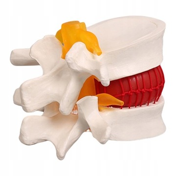 Anatomiczny model przepukliny dysku Model