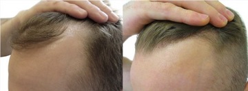 ДЕРМА РОЛИК для волос для роста волос уменьшает облысение кожи головы