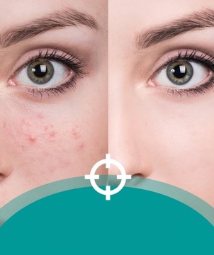 Zestaw do Usuwania Zaskórników Stal Nierdzewna PRO Oczyszczania Twarzy 13el