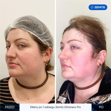 Подъемное устройство SMAS Zemits UltraNexx Pro