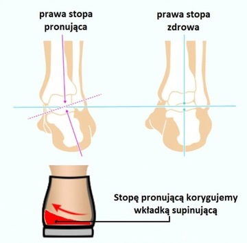WKŁADKI ORTOPEDYCZNE SUPINUJĄCE KOŚLAWOŚĆ U DZIECI