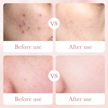 Увлажняющая сыворотка для лица с гиалуроновой кислотой, против морщин,