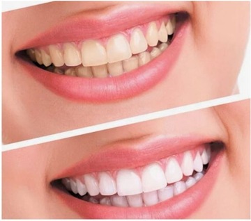 ЗУБОВОЙ СКЕЙЛЕР ДЛЯ УДАЛЕНИЯ НАКИПИ ЗВУКОВОЙ ЩЕТКОЙ СУПЕР СИЛЬНЫЙ