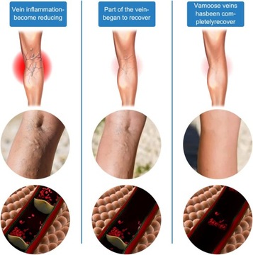 АППАРАТ NAVIGATEE ДЛЯ УДАЛЕНИЯ АКНЕ И Варикозного расширения вен