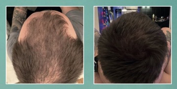 Энзимный пилинг кожи головы 50 мл TRICHO T-derm Series