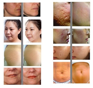 Mezoterapia Igłowa Rolka 540 Igieł Derma Roller Masażer Twarzy Mikroigłowy