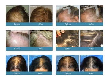 Инфракрасный шлем для роста волос Рост волос