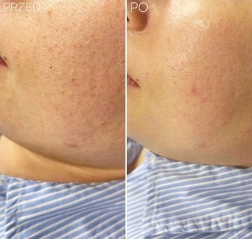 Безыгольная мезотерапия SKINLOVERS MEZO Массажер 5в1 Роллер ПОДАРОК ​​|