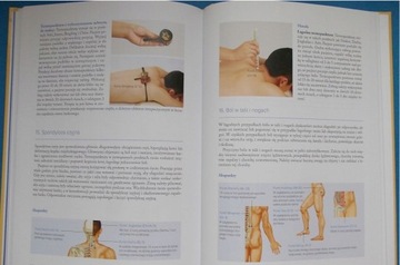 МОКСОТЕРАПИЯ ---- Мокса --- Термальная иглоукалывание