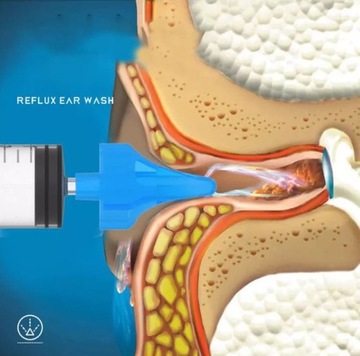 ШПРИЦ ДЛЯ ПРОМЫВАНИЯ НОСА 10МЛ 2 ШТ (B1714)