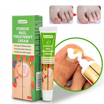 Paronychia Onychomycosis maść Toe pielęgnacja tynk