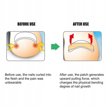 КОРРЕКЦИОННЫЙ НАБОР КРОНШТЕЙН ДЛЯ ВРАСТАЮЩЕЙ КОРРЕКЦИОННОЙ ЛЕНТЫ ДЛЯ НОГТЕЙ НА ПАЛЬЦАХ НОГ