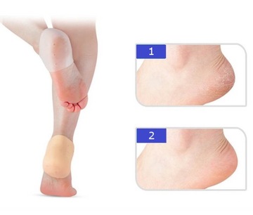 ГЕЛЕВЫЕ ПОКРЫТИЯ ПРИ ТРЕЩИНАХ ПЯТОК, ТРАВМАХ, БЛИКЕРАХ