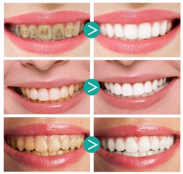 Пена для отбеливания зубов Teethaid