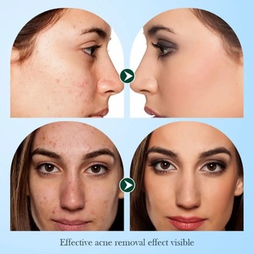 Противовоспалительный, антиакне, крем против прыщей,