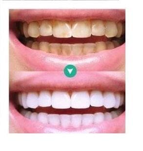 ЗУБОВОЙ СКЕЙЛЕР ДЛЯ УДАЛЕНИЯ НАКИПИ ЗВУКОВОЙ ЩЕТКОЙ СУПЕР СИЛЬНЫЙ