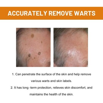 Leczenie brodawek jadem pszczelim Hidradenitis Suppurativa Spray Usuń znacz
